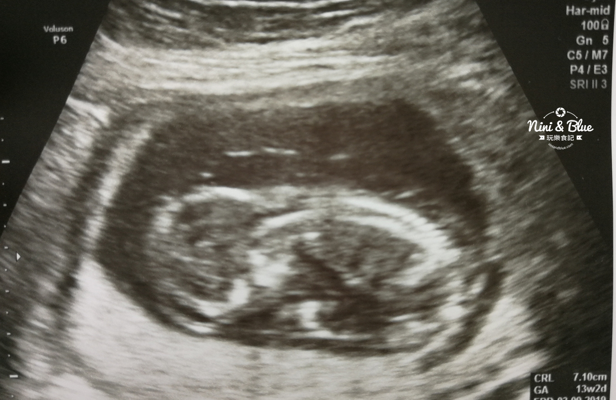 試管嬰兒 雙胞胎萎縮 14週引產